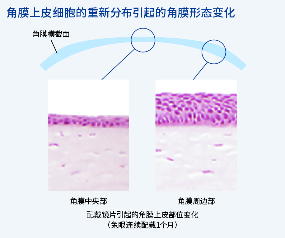 图：角膜上皮细胞的重新分布引起的角膜形状变化