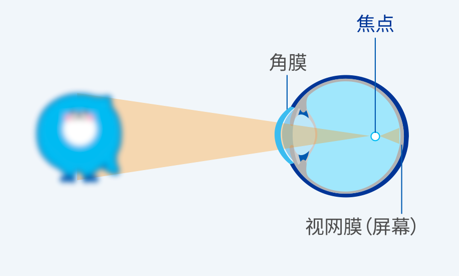 图：什么是近视？